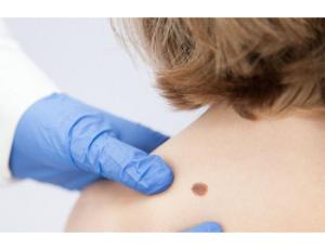 Новообразования кожи в практике дерматовенеролога